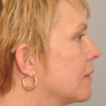 Lower Facelift/Necklift Delaware | Premier Cosmetic Surgery DE