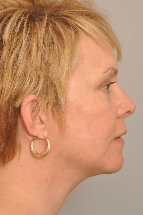 Lower Facelift/Necklift Delaware | Premier Cosmetic Surgery DE