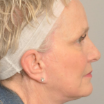 Lower Facelift/Necklift Delaware | Premier Cosmetic Surgery DE