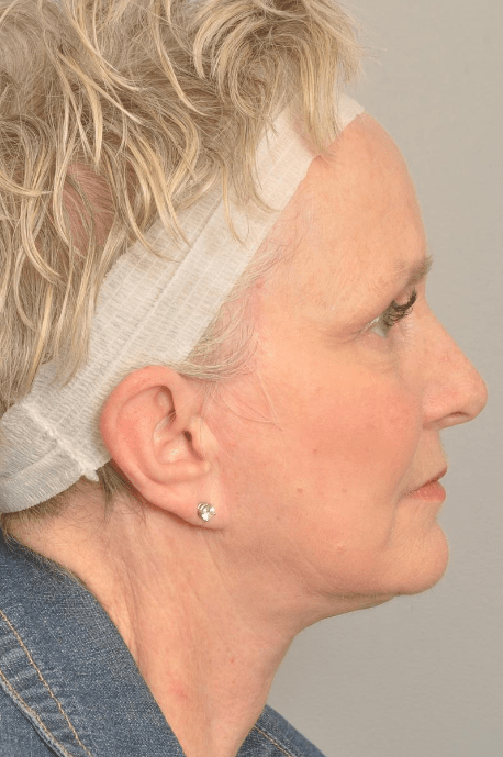 Lower Facelift/Necklift Delaware | Premier Cosmetic Surgery DE