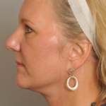 Lower Facelift/Necklift Delaware | Premier Cosmetic Surgery DE