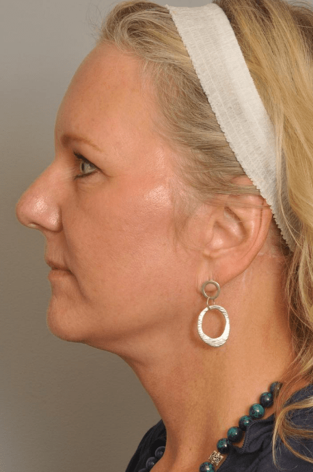 Lower Facelift/Necklift Delaware | Premier Cosmetic Surgery DE