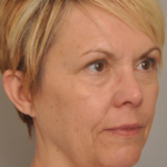 Lower Facelift/Necklift Delaware | Premier Cosmetic Surgery DE