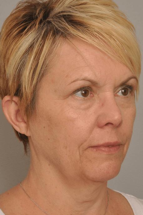 Lower Facelift/Necklift Delaware | Premier Cosmetic Surgery DE