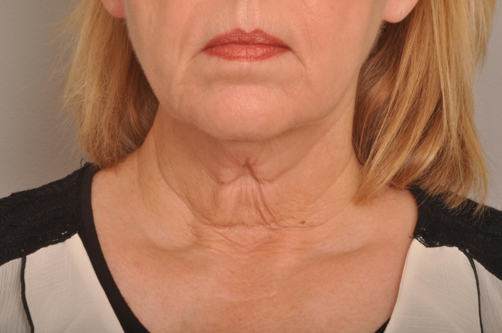 Lower Facelift/Necklift Delaware | Premier Cosmetic Surgery DE