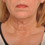 Lower Facelift/Necklift Delaware | Premier Cosmetic Surgery DE