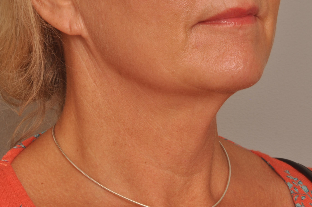 Lower Facelift/Necklift Delaware | Premier Cosmetic Surgery DE