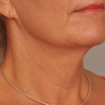 Lower Facelift/Necklift Delaware | Premier Cosmetic Surgery DE