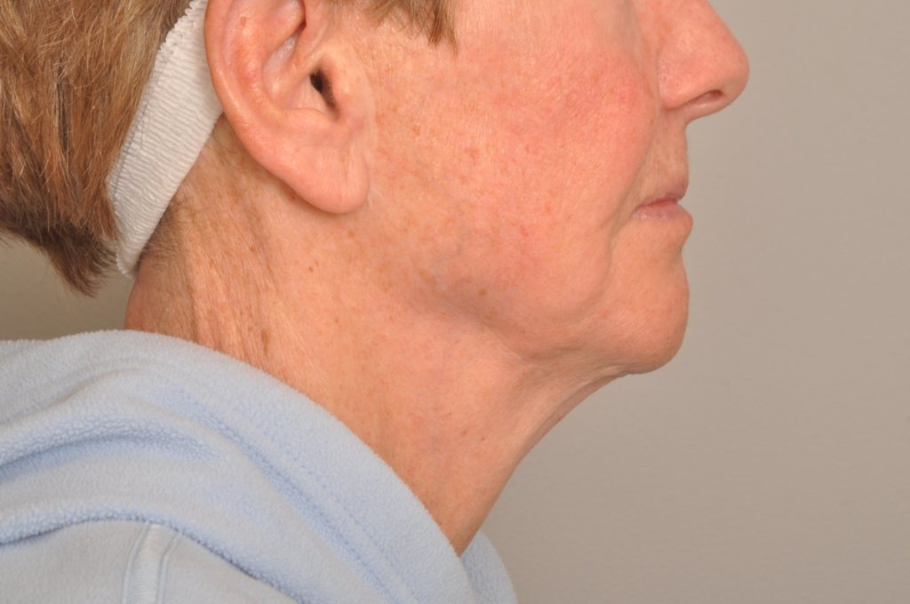 Lower Facelift/Necklift Delaware | Premier Cosmetic Surgery DE