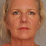 Lower Facelift/Necklift Delaware | Premier Cosmetic Surgery DE