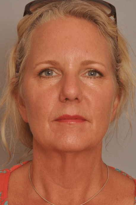 Lower Facelift/Necklift Delaware | Premier Cosmetic Surgery DE