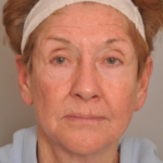 Lower Facelift/Necklift Delaware | Premier Cosmetic Surgery DE