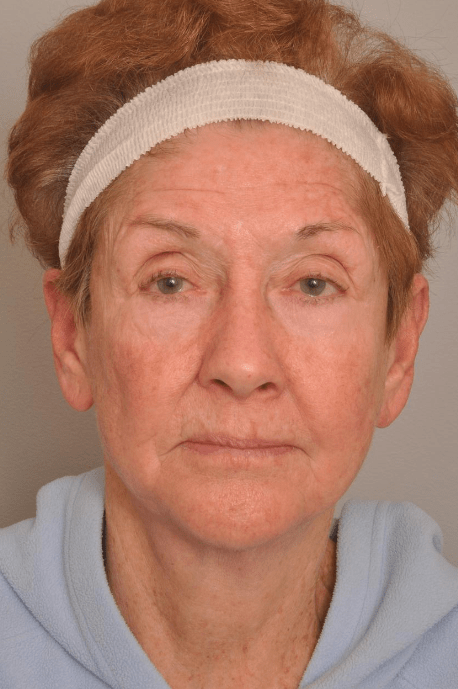 Lower Facelift/Necklift Delaware | Premier Cosmetic Surgery DE