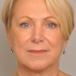 Lower Facelift/Necklift Delaware | Premier Cosmetic Surgery DE