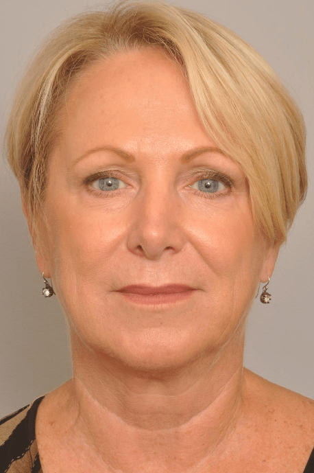 Lower Facelift/Necklift Delaware | Premier Cosmetic Surgery DE