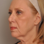 Lower Facelift/Necklift Delaware | Premier Cosmetic Surgery DE