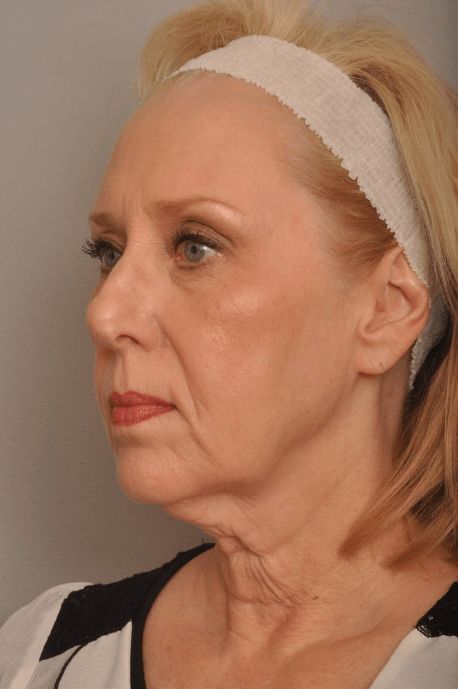 Lower Facelift/Necklift Delaware | Premier Cosmetic Surgery DE