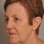 Lower Facelift/Necklift Delaware | Premier Cosmetic Surgery DE