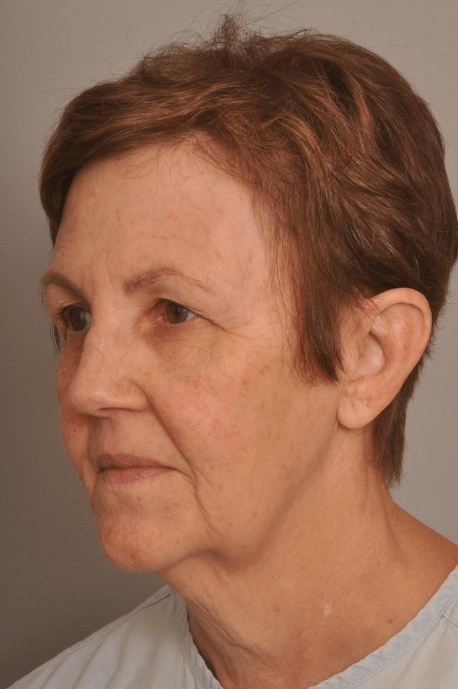 Lower Facelift/Necklift Delaware | Premier Cosmetic Surgery DE