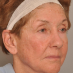 Lower Facelift/Necklift Delaware | Premier Cosmetic Surgery DE