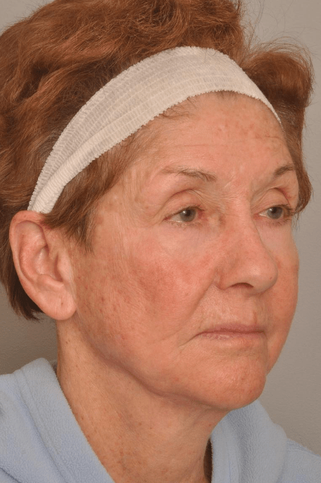 Lower Facelift/Necklift Delaware | Premier Cosmetic Surgery DE