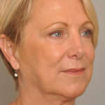 Lower Facelift/Necklift Delaware | Premier Cosmetic Surgery DE