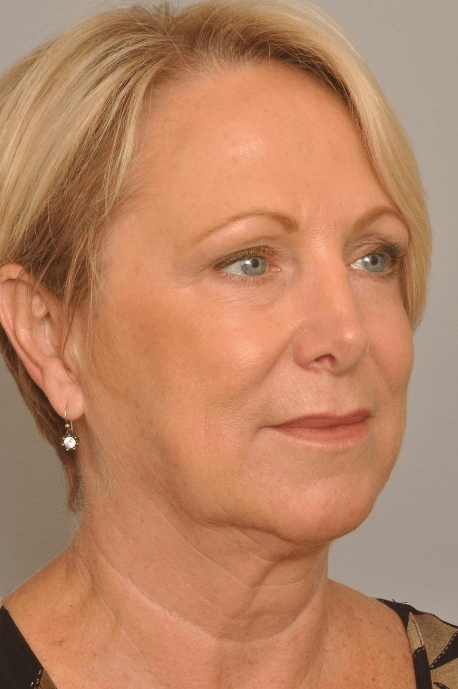 Lower Facelift/Necklift Delaware | Premier Cosmetic Surgery DE