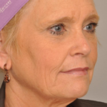 Lower Facelift/Necklift Delaware | Premier Cosmetic Surgery DE