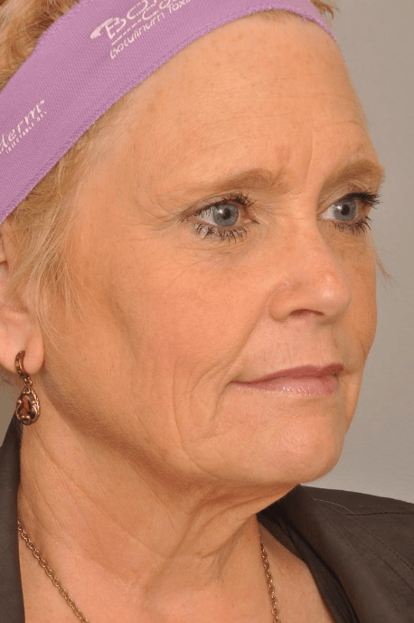 Lower Facelift/Necklift Delaware | Premier Cosmetic Surgery DE