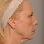 Lower Facelift/Necklift Delaware | Premier Cosmetic Surgery DE