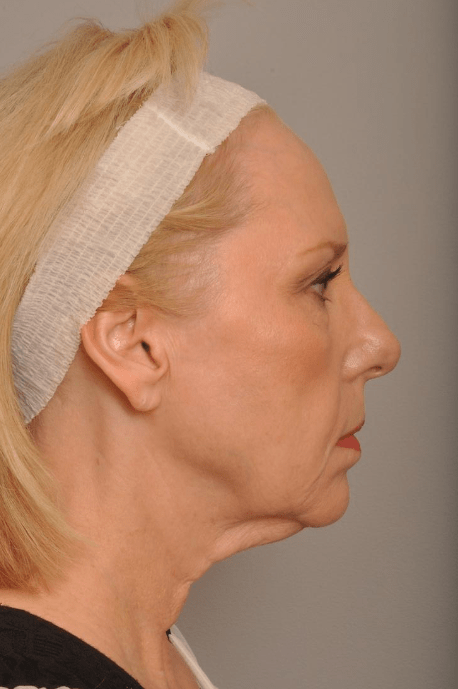 Lower Facelift/Necklift Delaware | Premier Cosmetic Surgery DE