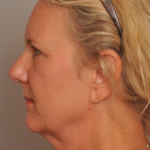 Lower Facelift/Necklift Delaware | Premier Cosmetic Surgery DE