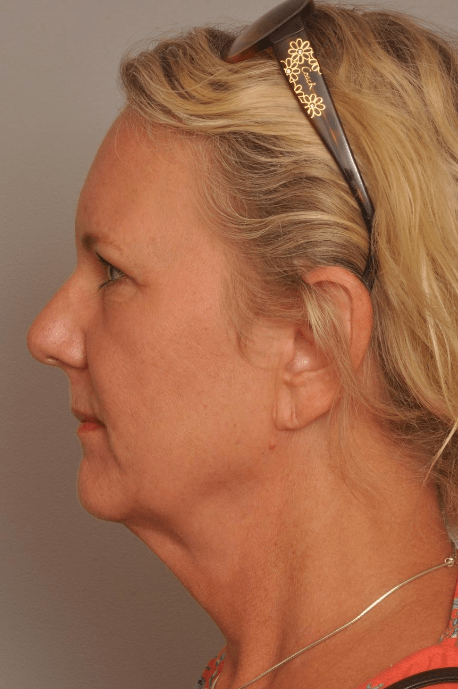 Lower Facelift/Necklift Delaware | Premier Cosmetic Surgery DE