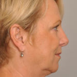 Lower Facelift/Necklift Delaware | Premier Cosmetic Surgery DE