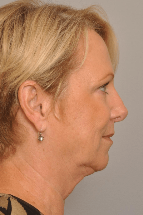 Lower Facelift/Necklift Delaware | Premier Cosmetic Surgery DE