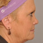 Lower Facelift/Necklift Delaware | Premier Cosmetic Surgery DE