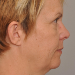 Lower Facelift/Necklift Delaware | Premier Cosmetic Surgery DE