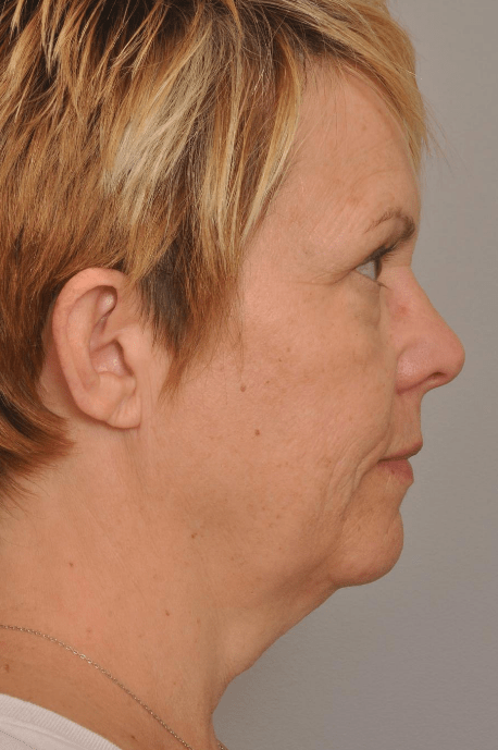 Lower Facelift/Necklift Delaware | Premier Cosmetic Surgery DE