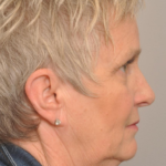 Lower Facelift/Necklift Delaware | Premier Cosmetic Surgery DE