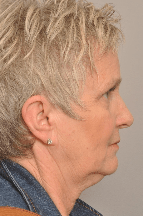 Lower Facelift/Necklift Delaware | Premier Cosmetic Surgery DE