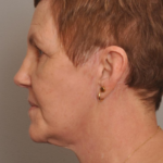 Lower Facelift/Necklift Delaware | Premier Cosmetic Surgery DE