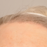 Hair Restoration Delaware | Premier Cosmetic Surgery DE