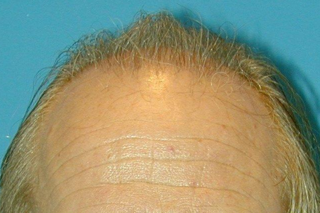 Hair Restoration Delaware | Premier Cosmetic Surgery DE