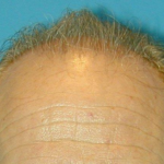 Hair Restoration Delaware | Premier Cosmetic Surgery DE