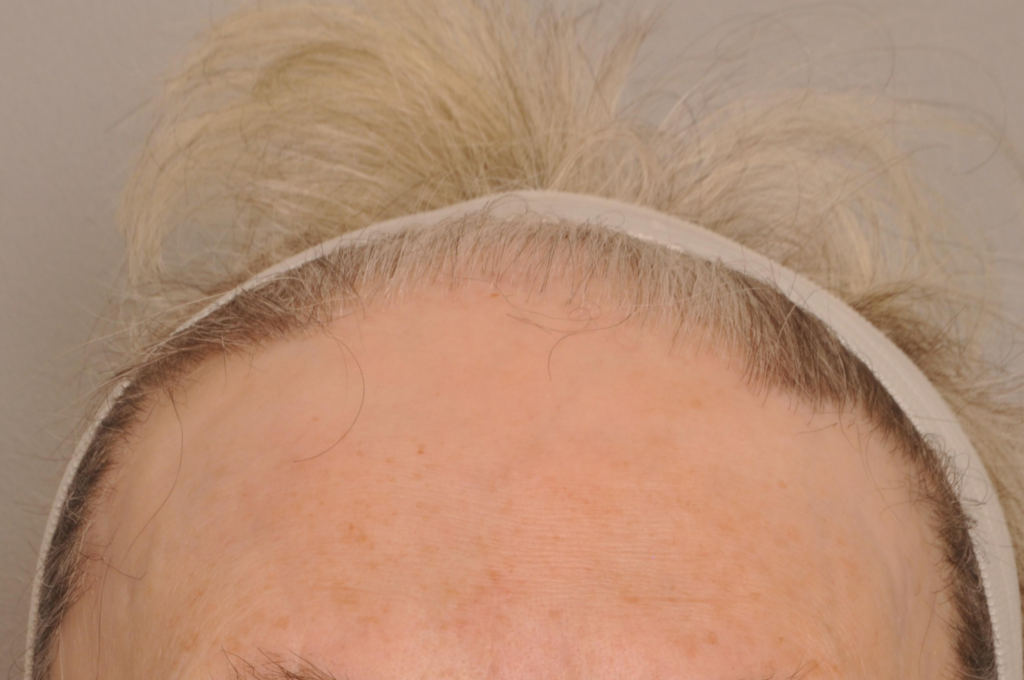 Hair Restoration Delaware | Premier Cosmetic Surgery DE