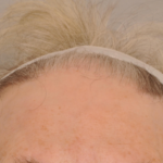 Hair Restoration Delaware | Premier Cosmetic Surgery DE