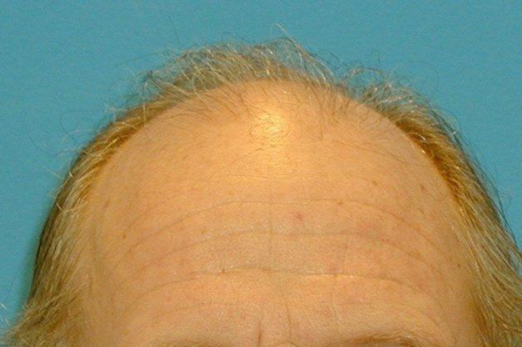 Hair Restoration Delaware | Premier Cosmetic Surgery DE