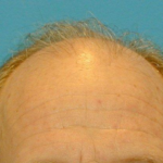 Hair Restoration Delaware | Premier Cosmetic Surgery DE