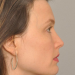 Kybella Delaware | Premier Cosmetic Surgery DE