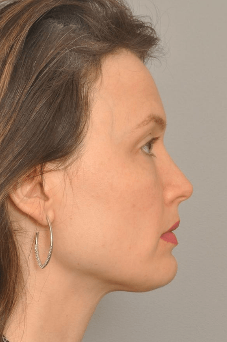 Kybella Delaware | Premier Cosmetic Surgery DE